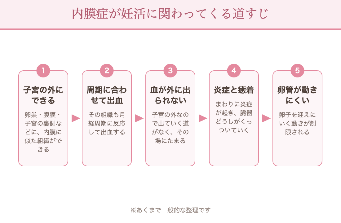 内膜症が妊活に関わる道すじ：子宮の外にできる→周期に合わせて出血→血が外に出られない→炎症と癒着→卵管が動きにくい